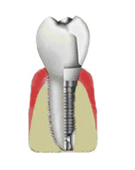 Dr. Becker Implantat